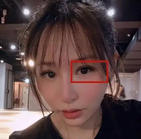 女星割双眼皮如跨分水岭,没整好变悲伤蛙,成功则变气质美女