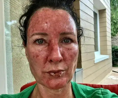 美人鱼不能涂防晒霜美国女子沉迷幻想结果得了皮肤癌