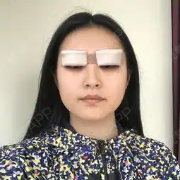 今天终于鼓起勇气做了双眼皮,和医院的美女聊了好久,...开眼角悦美整形