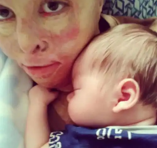 瓦斯爆炸80灼伤,36次手术挽救生命,美国女孩找到真爱做了母亲