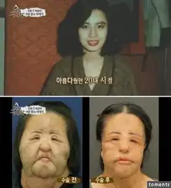 14个女人整形的失败案例,其中一个完全让我吓傻了