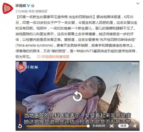 印度一名新生女婴患罕见遗传病出生时四肢缺失