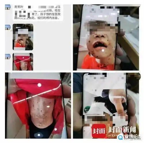 女童遭继母殴打进icu,生母崩溃,邻居嘴唇被剪掉,继母说孩子自己打自己