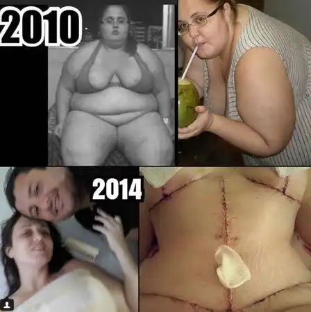 英国美女网红减肥做缩胃手术切除120cm肠子,无法进食快瘦成骷髅