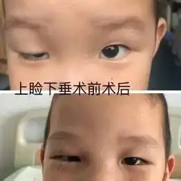 儿童近视的三大误区有哪些太原市人民医院眼科专家教你如何正确预防近视