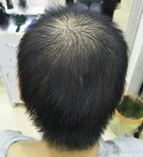 女生脱发了那么多年的我,经历了无尽的心酸