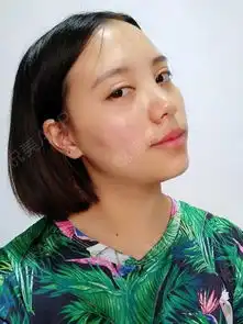 做了微调,玻尿酸丰下巴,看了大家做的,各个都是美女...填充塑形悦美整形