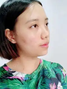 做了微调,玻尿酸丰下巴,看了大家做的,各个都是美女...填充塑形悦美整形