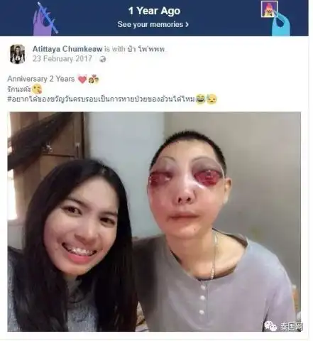 男友患病毁容,泰国女孩相伴3年不离不弃