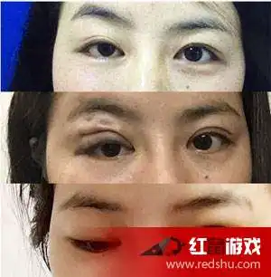 女子整形变大小眼左眼不能完全闭合
