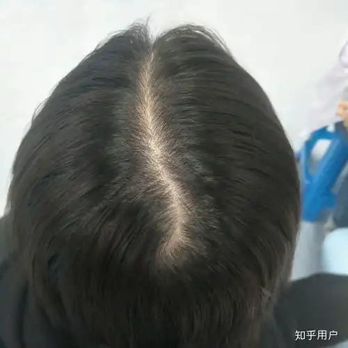 女生头发少,是一种什么体验