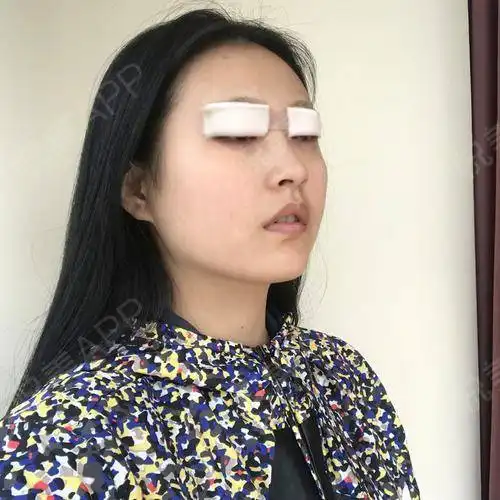 今天终于鼓起勇气做了双眼皮,和医院的美女聊了好久,...开眼角悦美整形
