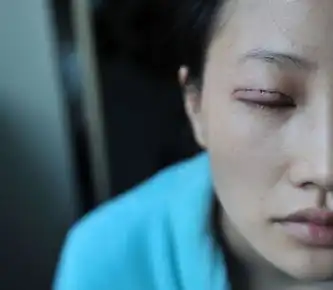 摄影师拍韩国女子整容后恢复期真实照片