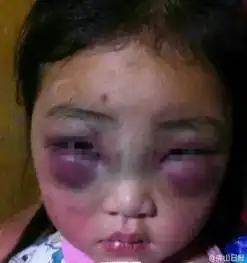 慎点太残忍江苏女童疑遭父母殴打虐待