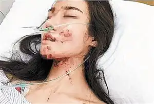 网红美女七夕坐宝马遭毁容肇事司机逃逸