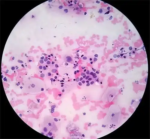 45岁女子长期腿痛,查出宫颈癌晚期,提醒3个暗示信号别忽视