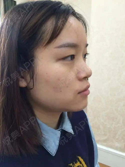 和很多女孩子一样,我也希望有一双闪亮亮的大眼睛,但...眼整形失败修复悦美整形