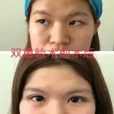 儿童近视的三大误区有哪些太原市人民医院眼科专家教你如何正确预防近视