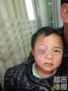 商洛3岁女童在家门口遭枪击,导致右眼失明孩子的伤情让人揪心