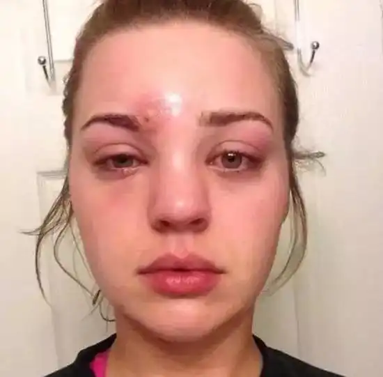 手残党必看挤痘痘很爽吗推特女神挤了痘,却差点毁了容