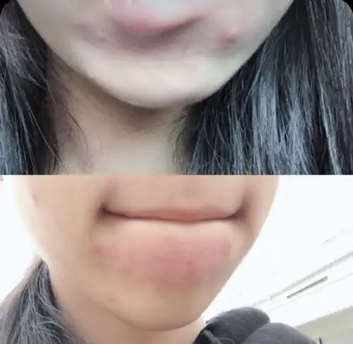 这款口碑爆炸的祛痘膏99的战痘少女都在靠它续命